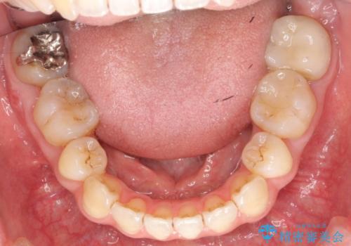 銀歯を白く　セラミッククラウンに　矯正後のやり変えの治療前