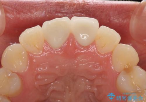 セラミッククラウンによる前歯の形態改善の治療後