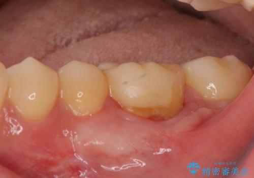 下がった歯茎を改善　歯肉移植による根面被覆の治療後