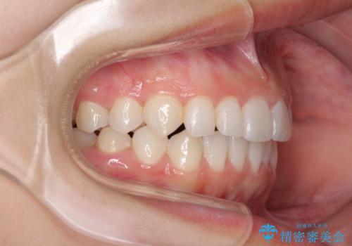 前歯のでこぼこと咬み合わせの改善　インビザラインでのスピード矯正の治療後