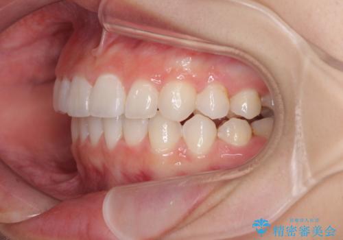 前歯のでこぼこと咬み合わせの改善　インビザラインでのスピード矯正の治療後