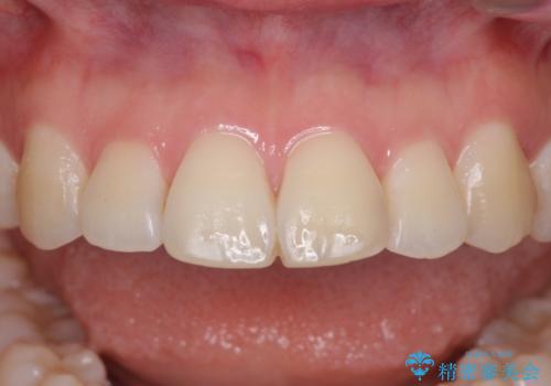 セラミッククラウンによる前歯の形態改善の治療前