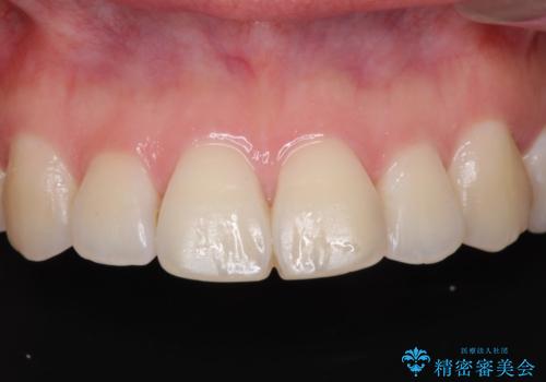 セラミッククラウンによる前歯の形態改善の治療前