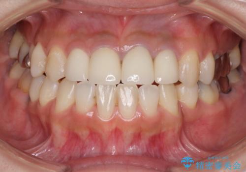変色した保険診療の前歯をセラミックできれいに　矯正治療後の審美治療