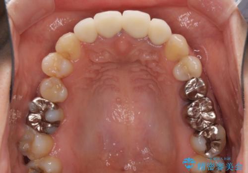 変色した保険診療の前歯をセラミックできれいに　矯正治療後の審美治療の治療後