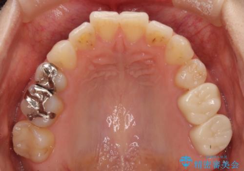 奥歯の銀歯をセラミックで白い歯にの治療前