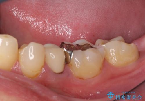 親知らず抜歯と下奥歯の被せものの治療前