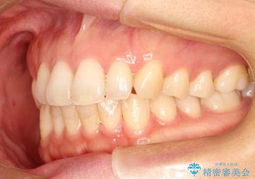 前歯のクロスバイトをインビザラインとマイクロインプラントのコンビネーションで短期間に治すの治療前