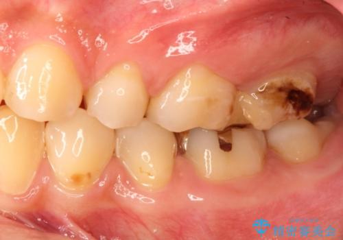 奥歯で広がった虫歯、中途半端な仮詰め状態をセラミッククラウンで解消するの治療前