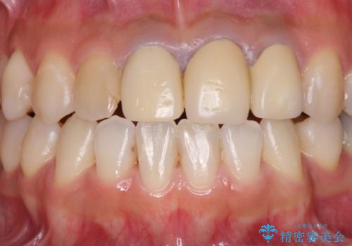 変色した保険診療の前歯をセラミックできれいに　矯正治療後の審美治療の治療前