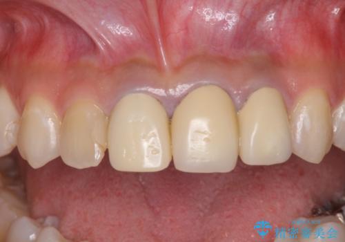 変色した保険診療の前歯をセラミックできれいに　矯正治療後の審美治療の治療前
