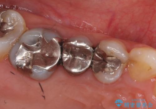 オールセラミッククラウン　銀歯を白い歯への治療前
