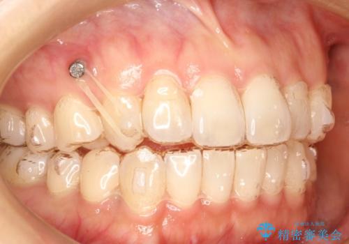 前歯のクロスバイトをインビザラインとマイクロインプラントのコンビネーションで短期間に治すの治療中