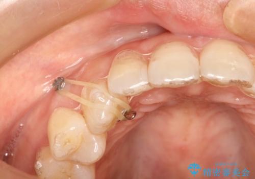 前歯のクロスバイトをインビザラインとマイクロインプラントのコンビネーションで短期間に治すの治療中