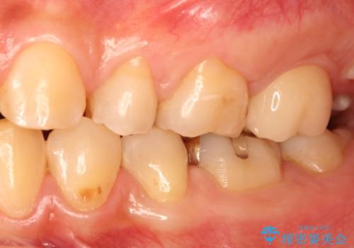 奥歯で広がった虫歯、中途半端な仮詰め状態をセラミッククラウンで解消するの治療後
