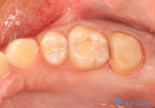 奥歯で広がった虫歯、中途半端な仮詰め状態をセラミッククラウンで解消するの治療中