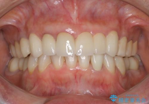 全顎修復　劣化したセラミックをやり直し～前歯の修復の治療後