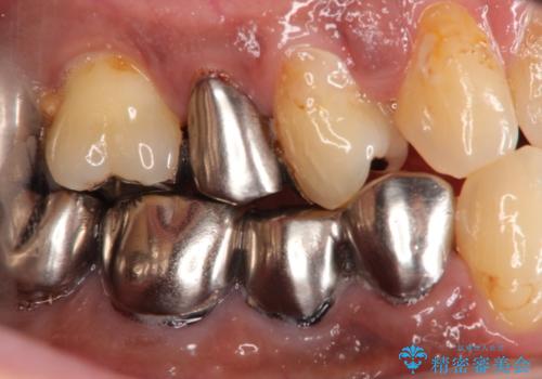 金属を白いものにして、悪いところを治したい　矯正治療も含めた総合歯科治療の治療前