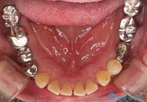 金属を白いものにして、悪いところを治したい　矯正治療も含めた総合歯科治療の治療前