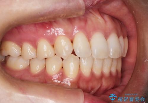前歯のクロスバイトをインビザラインとマイクロインプラントのコンビネーションで短期間に治すの治療後