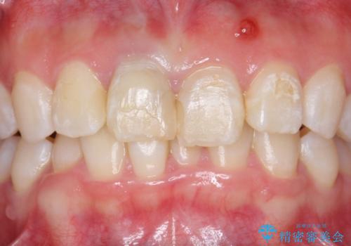 オールセラミッククラウン　前歯の色・形・がたがたを補綴で治したい　の治療前