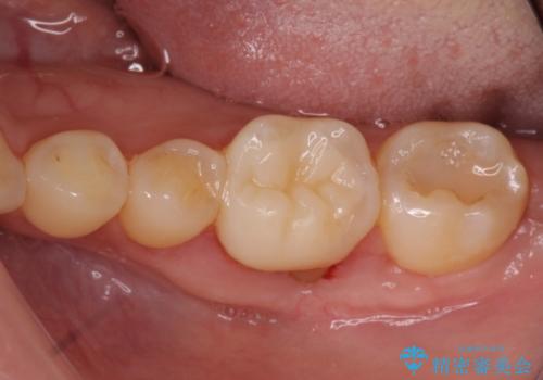 下がった歯茎を改善　歯肉移植による根面被覆の治療中