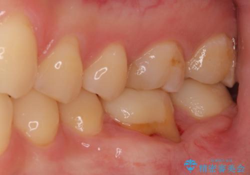下がった歯茎を改善　歯肉移植による根面被覆の治療中