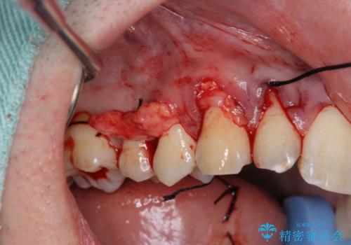 歯ぐきの下がりが気になる　歯肉移植による改善の治療中