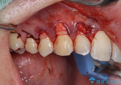 歯ぐきの下がりが気になる　歯肉移植による改善の治療中
