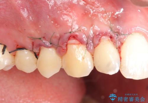 歯ぐきの下がりが気になる　歯肉移植による改善