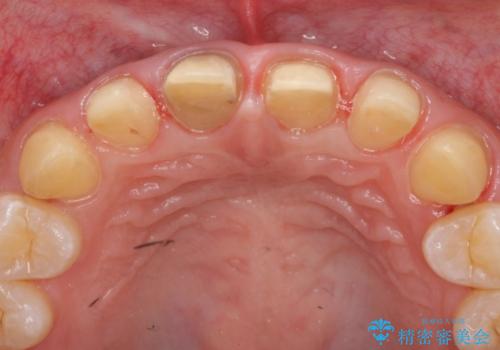 オールセラミッククラウン　前歯の色・形・がたがたを補綴で治したい　の治療中