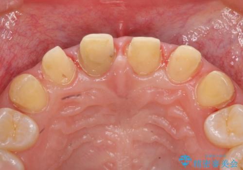 オールセラミッククラウン　前歯の色・形・がたがたを補綴で治したい　の治療中