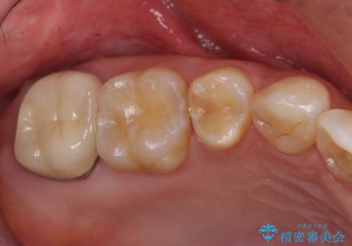 銀歯を白く　セラミッククラウンに　矯正後のやり変えの治療後