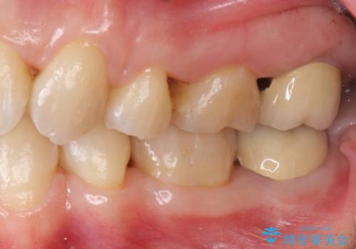銀歯を白く　セラミッククラウンに　矯正後のやり変えの治療後