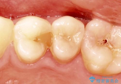 歯と歯の間の虫歯をセラミックインレーで修復の症例 治療前