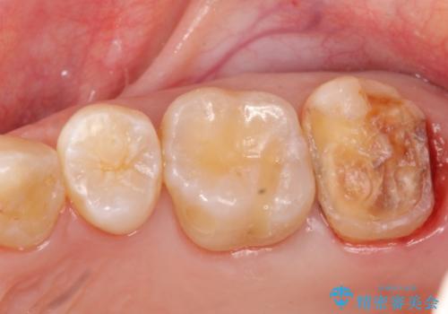 銀歯を白く　セラミッククラウンに　矯正後のやり変えの治療中