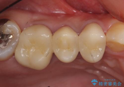 オールセラミッククラウン　銀歯を白い歯への治療後