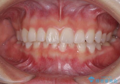 前歯のでこぼこと咬み合わせの改善　インビザラインでのスピード矯正の治療前
