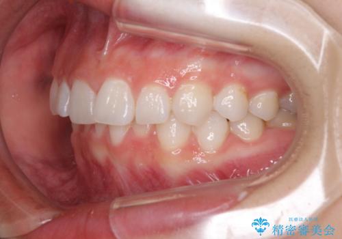 前歯のでこぼこと咬み合わせの改善　インビザラインでのスピード矯正の治療前