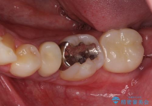 親知らず抜歯と下奥歯の被せものの治療後