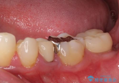 親知らず抜歯と下奥歯の被せものの治療後