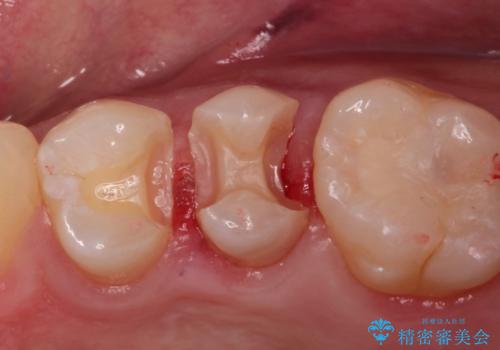 歯と歯の間の虫歯をセラミックインレーで修復の治療中