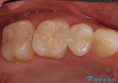 奥歯の銀歯をセラミックで白い歯にの治療後