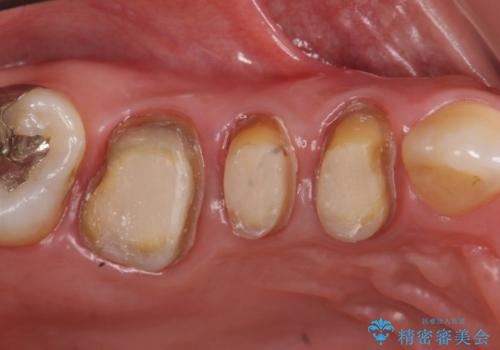オールセラミッククラウン　銀歯を白い歯への治療中
