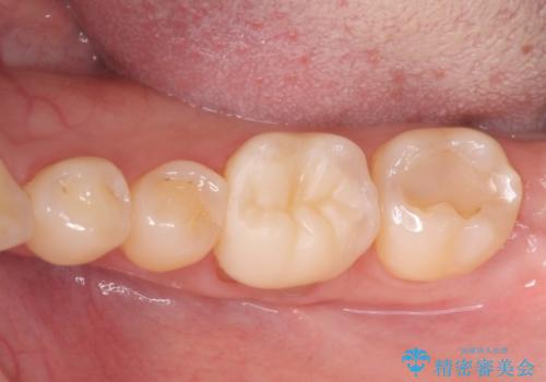 下がった歯茎を改善　歯肉移植による根面被覆の治療前
