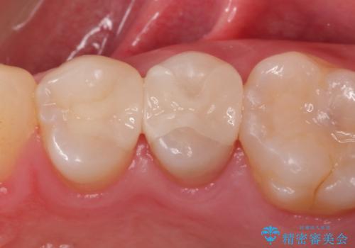 歯と歯の間の虫歯をセラミックインレーで修復