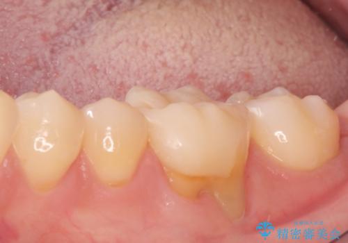 下がった歯茎を改善　歯肉移植による根面被覆の治療前
