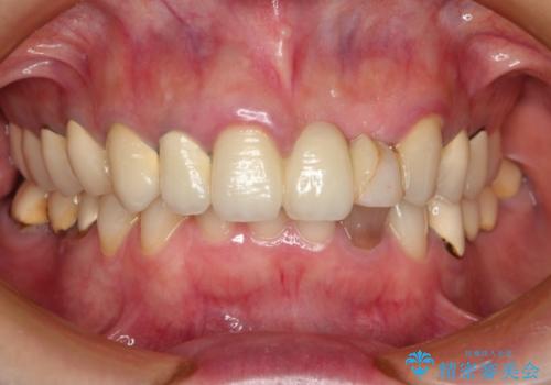 全顎修復　劣化したセラミックをやり直し～前歯の修復の治療前