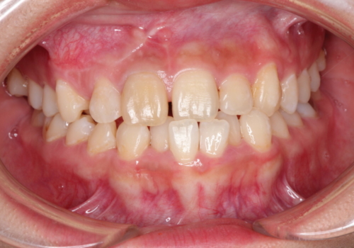 矯正治療に伴う犬歯埋伏抜歯の治療後