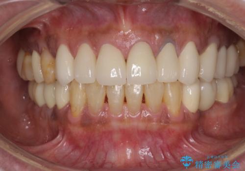 金属を白いものにして、悪いところを治したい　矯正治療も含めた総合歯科治療の治療後